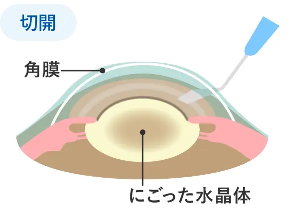 切開のイラスト